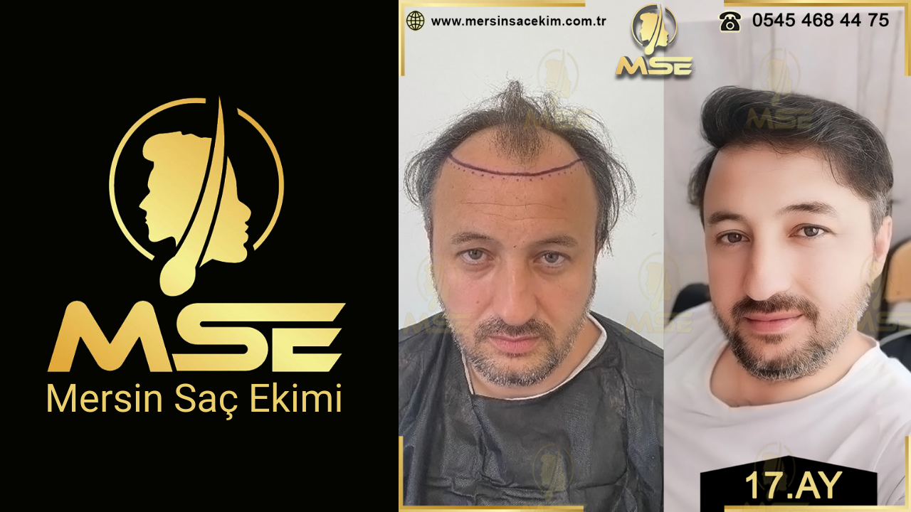 Mersin Saç Ekimi